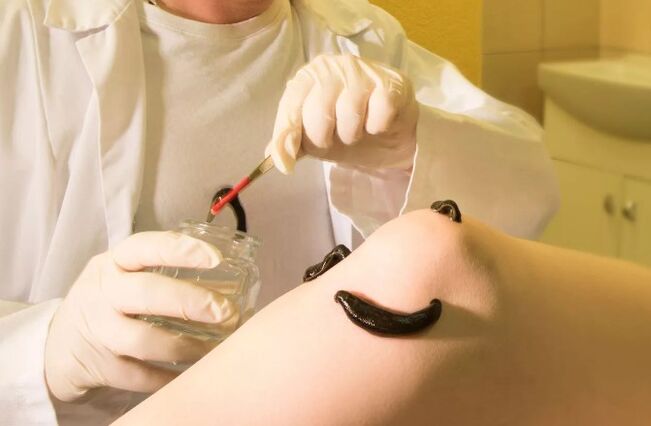 Surgery for varicose veins