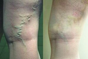 Varicose veins on their feet