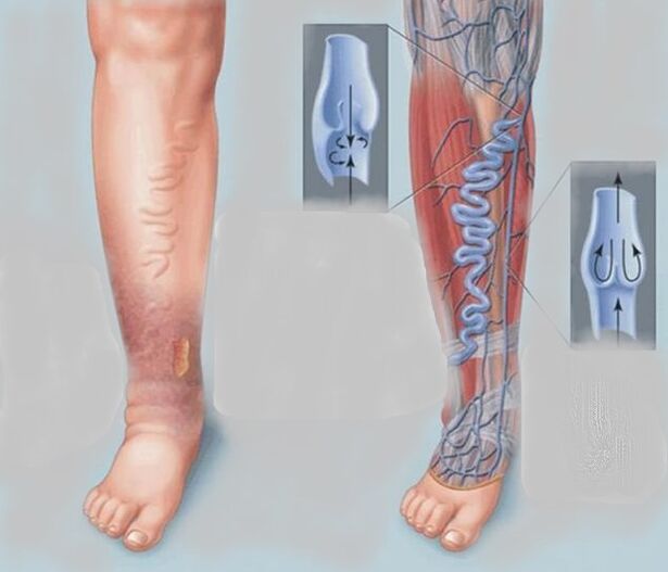 Varicose veins on their feet