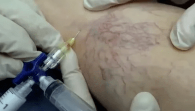 sclerotherapy of varicose veins