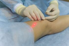 surgical intervention for varicose veins on the legs